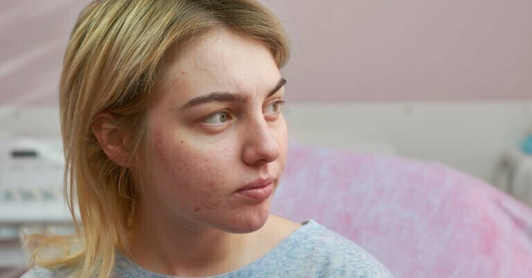 Chronic skin condition, girl with acne