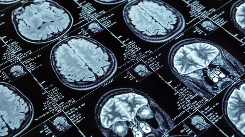 brain awareness MRI of a human brain